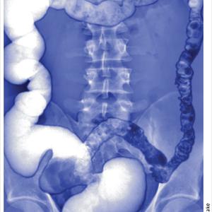 Irritable Bowel Syndrome In Children - Irritable Bowel Syndrome - Causes, Symptoms And Treatment Methods